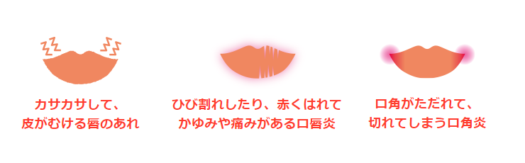 口唇のひびわれ、口唇のただれ、口唇炎、口角炎